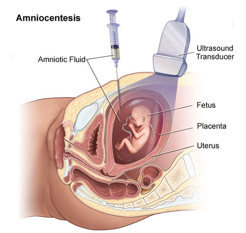 test-Amniocenteza