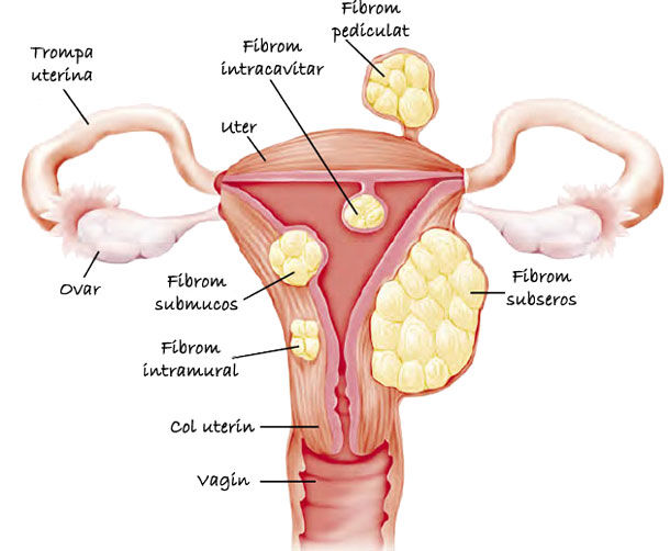 cum să pierdeți greutatea cu fibroame uterine