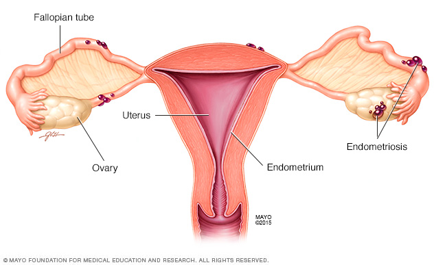 Varice ale uterului venelor pelvine